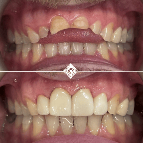Before & After - B. Simpson (1)