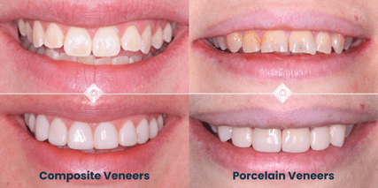 Composite vs Porcelain Veneers (1)