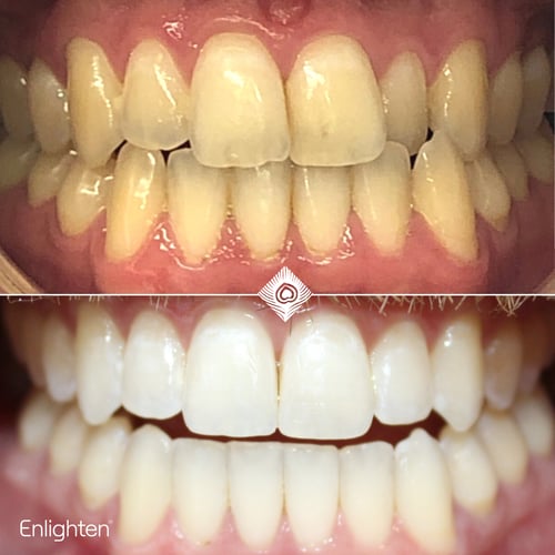 Enlighten Whitening Teeth
