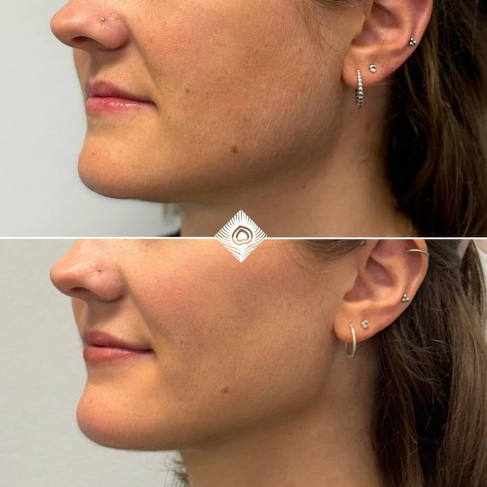 Facial Aesthetics Before & After (4)