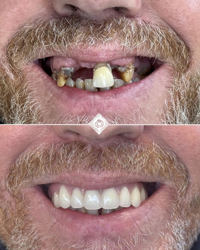 I. Parsons Before & After