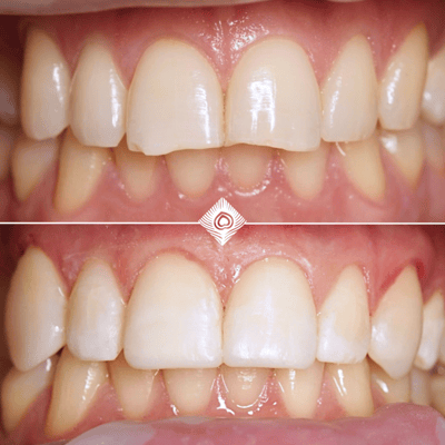 W. Gray Before & After